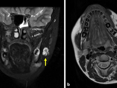 Unklare Raumforderung im M. masseter