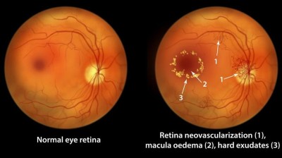 tirzepatide retinopathy Tirzepatide may protect against diabetic retinopathy