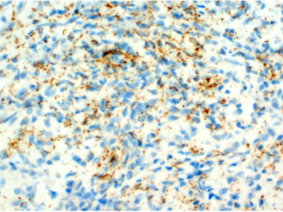 Syphilis | Syphilis mimicking a metastatic tumour: a case report and ...
