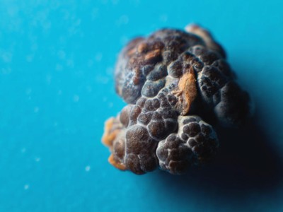 Parsley, pints, and potions: unraveling patient errors in kidney stone ...