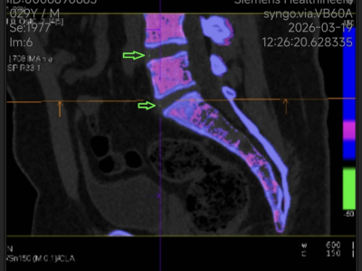 Ultrasound-based deep learning-derived radiomics for preoperative ...