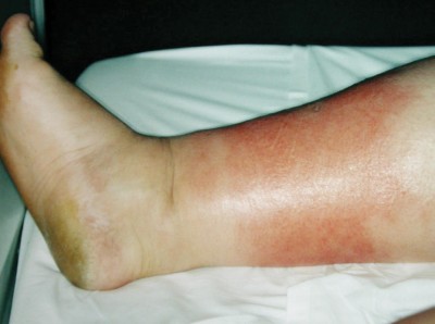 Geröteter Unterschenkel und Fieber