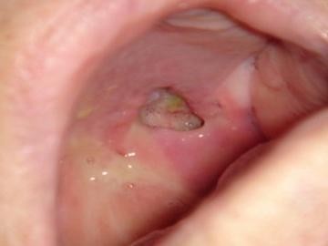 Was verursacht diese schmerzhaften Ulzera?