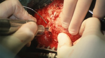 Hirnblutung  offen oder endoskopisch entfernen? | springermedizin.de