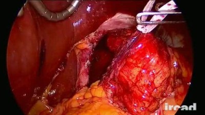 Video 03 - Dallemagne: Dissection_mediastinum_Sequenz 3_picture