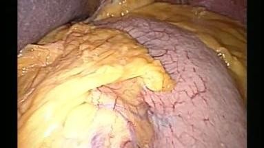 Video 08 - Corcione: Magenkarzinom_Gastrektomie_1_picture