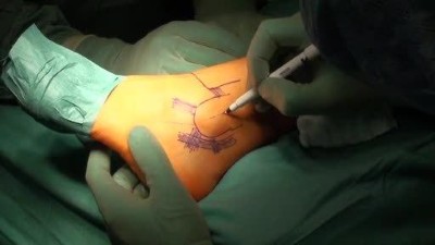 Fibulare Bandplastik bei chronischer lateraler Instabilität am oberen Sprunggelenk_picture