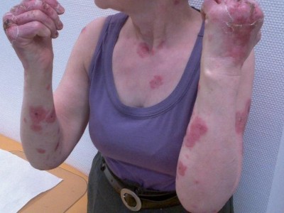 Erst Atemwegsinfekt, dann Dermatose
