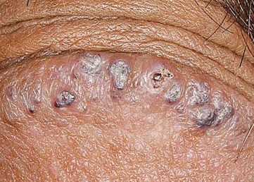 Penis weiße bläschen am Herpes