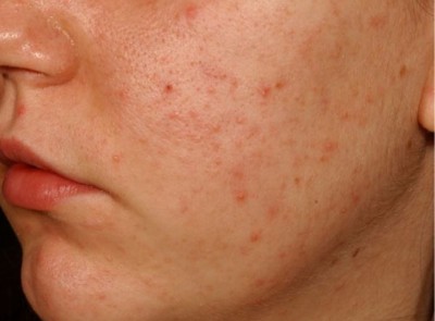 acne vulgaris mit probiotika oral und topisch gegen akne springermedizin de