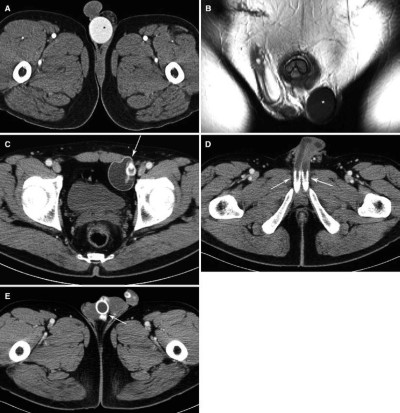 Penis implantat