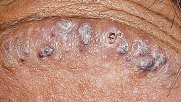 Pigmentstörung penis