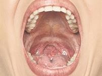 Morbus Crohn Der Mund Als Tor Zum Darm Springermedizin At