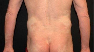 Ash 2017 Monoklonaler Antikorper Bereichert Therapie Kutaner T Zell Lymphome Springermedizin De
