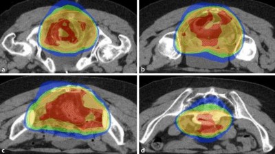 Rektumkarzinom: Häufiger Komplettresponse mit totaler neoadjuvanter ...