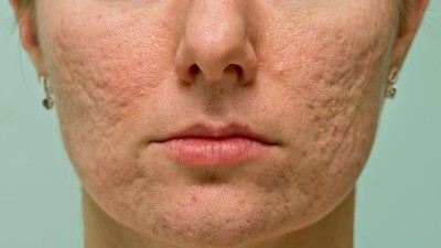 Acne Vulgaris Silikongel Und Laser Ein Dreamteam Gegen Aknenarben Springermedizin De
