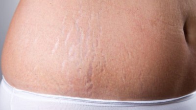 Microneedling | Mikronadeln lassen Dehnungsstreifen verschwinden |  springermedizin.de