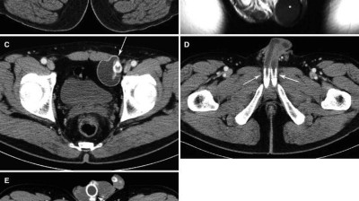 Radiologische Kongresse, Penis-Implantat: Was Radiologen erwartet