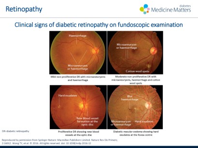 diabetic retinopathy ada)