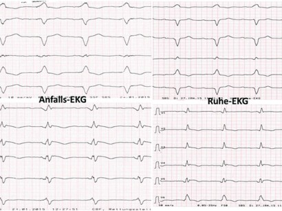 Erkrankungen Des Myokards Erkrankungen Des Myokards Springermedizin De