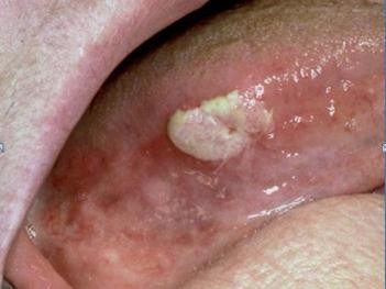 Significante toename mondkanker | mijn-bsl