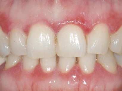Mundschleimhauterkrankungen Lichen Planus Tipps Zur Diagnose Und Therapie Springermedizin At
