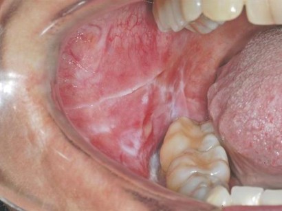 Mundschleimhauterkrankungen Lichen Planus Tipps Zur Diagnose Und Therapie Springermedizin At