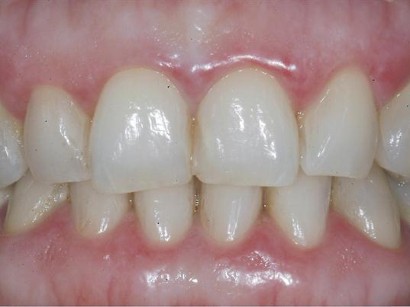 Mundschleimhauterkrankungen Lichen Planus Tipps Zur Diagnose Und Therapie Springermedizin At