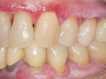 Mundschleimhauterkrankungen Lichen Planus Tipps Zur Diagnose Und Therapie Springermedizin At