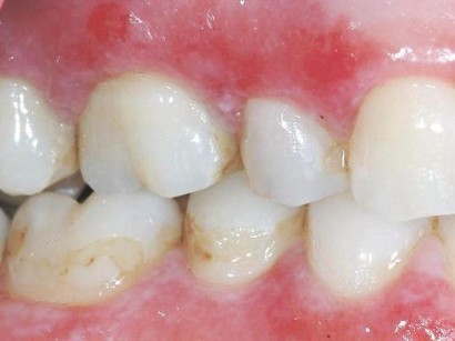 Mundschleimhauterkrankungen Lichen Planus Tipps Zur Diagnose Und Therapie Springermedizin At