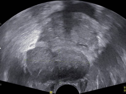 Prostatakarzinom aktuelle aspekte in der diagnostik und therapie