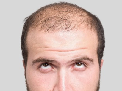 Alopezie Alopezie Springermedizin De