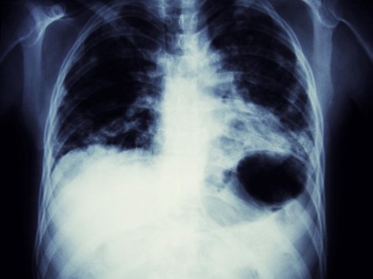 Lungenkarzinome Lungenkrebs Themenseite Springermedizin De