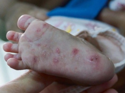 Hepatitis b hautveraenderungen,Infektionskrankheiten Der Haut Infektionskrankheiten Der Haut Springermedizin De
