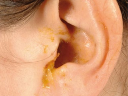 Otitis Externa Otitis Externa Springermedizin De Ent glue ear ottitis media with effusion child serous secretory mucoid podrobnee. otitis externa otitis externa