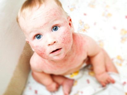 Hauterkrankungen In Der Hausarztpraxis Hauterkrankungen In Der Hausarztpraxis Springermedizin De