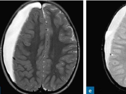 Raumfordernde Spinale Prozesse Raumfordernde Spinale Prozesse Springermedizin De