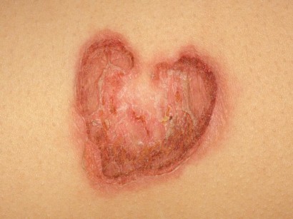Infektionskrankheiten Der Haut Infektionskrankheiten Der Haut Springermedizin De