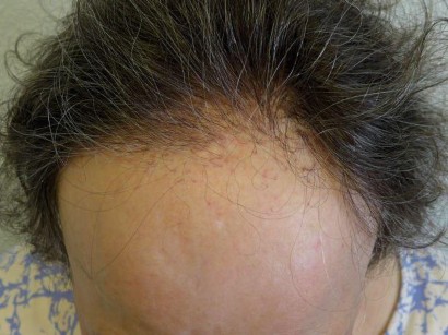 Alopezie Alopezie Springermedizin De