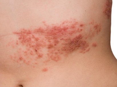 Hepatitisviren Hepatitis A Hepatitis B Hepatitis C Hepatistis D Hepatitis E Springermedizin De