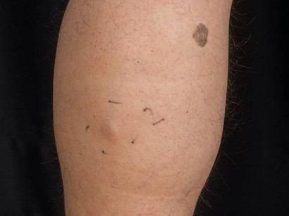 Knubbel unterm arm