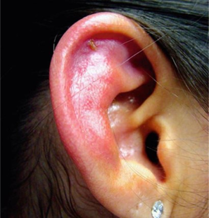 Ohr piercing entzündet Behandlung von