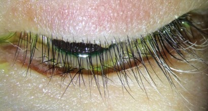 Akute Lymphatische Leukamie Weissfarbung Ohne Coiffeur Springermedizin De
