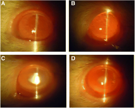 Cataract