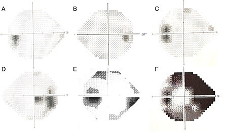 Featured consensus article: EHF Idiopathic