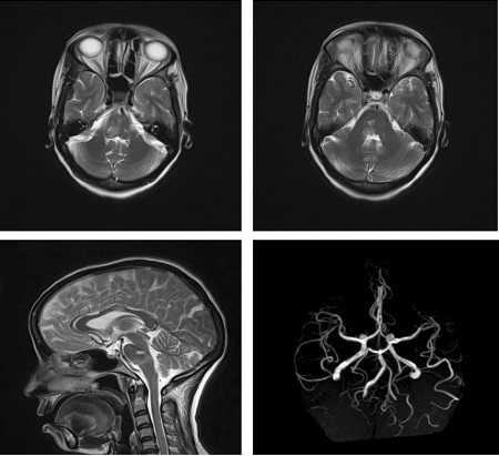 Twenty and a half syndrome
