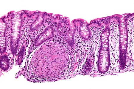 640px-Crohn's_disease_-_colon_-_high_mag