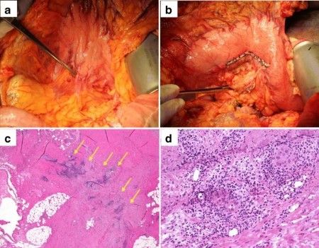 Needle tract seeding following endoscopic ultrasound-guided fine-needle aspiration for pancreatic cancer: a report of two cases