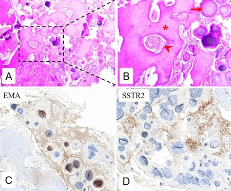 Thoracic psammomatous meningioma with osseous metaplasia: a controversial diagnosis of a case report and literature review