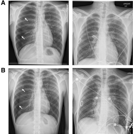 Recurrent spontaneous pneumothoraces and vaping in an 18-year-old boy: a case report and review of the literature